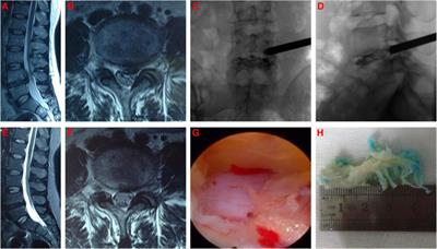 Nomogram for predicting the unfavourable outcomes of percutaneous endoscopic transforaminal discectomy for lumbar disc herniation: a retrospective study
